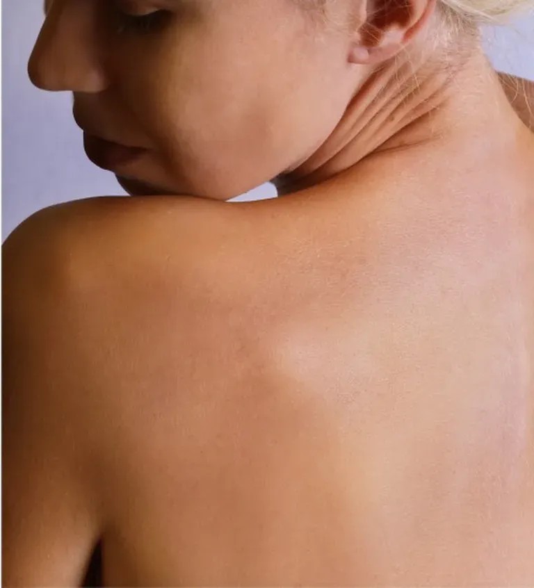 After laser tattoo removal — Upper Back / Shoulder