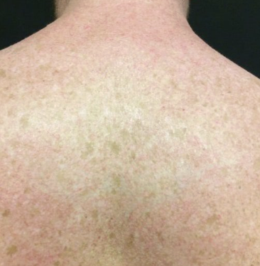 After laser tattoo removal — Upper Back