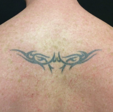 Before laser tattoo removal — Upper Back