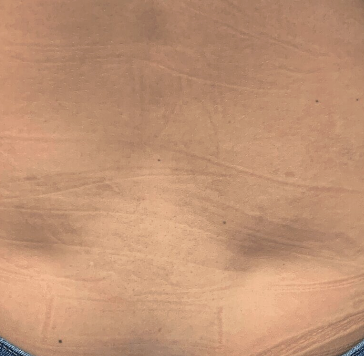 After laser tattoo removal — Lower Back