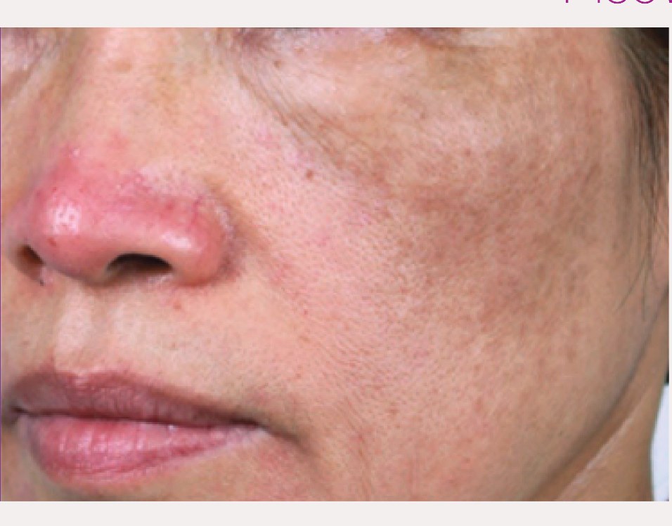 Before laser tattoo removal — Forearm · Cosmetic Ink