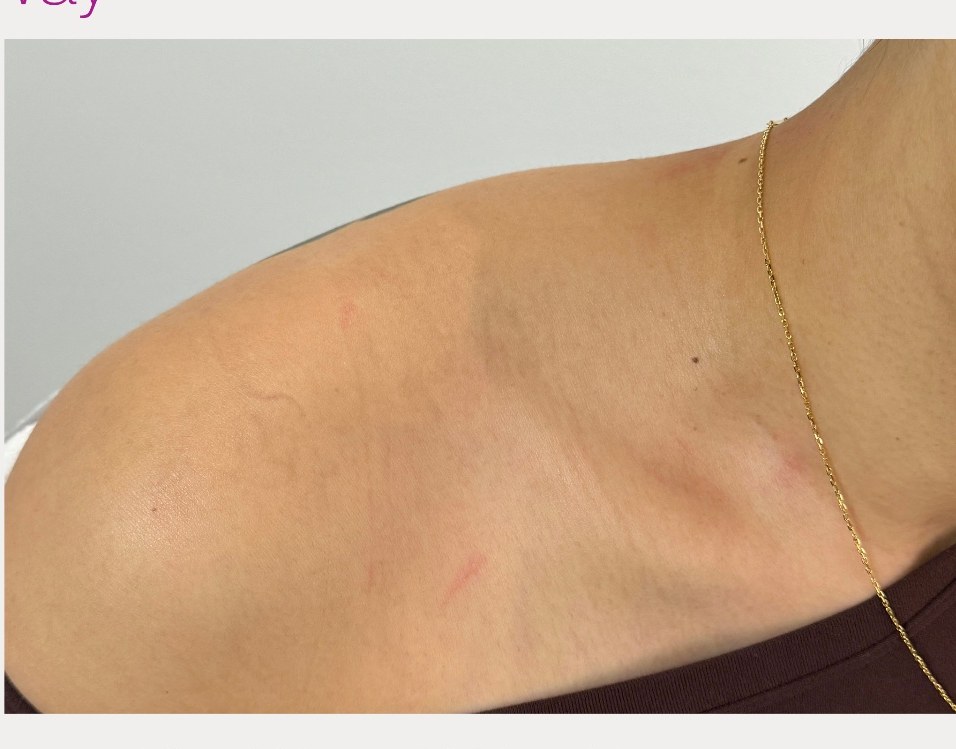 After laser tattoo removal — Collarbone · Script
