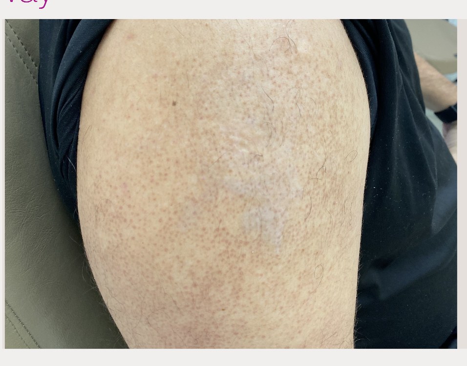 After laser tattoo removal — Calf · Large Black