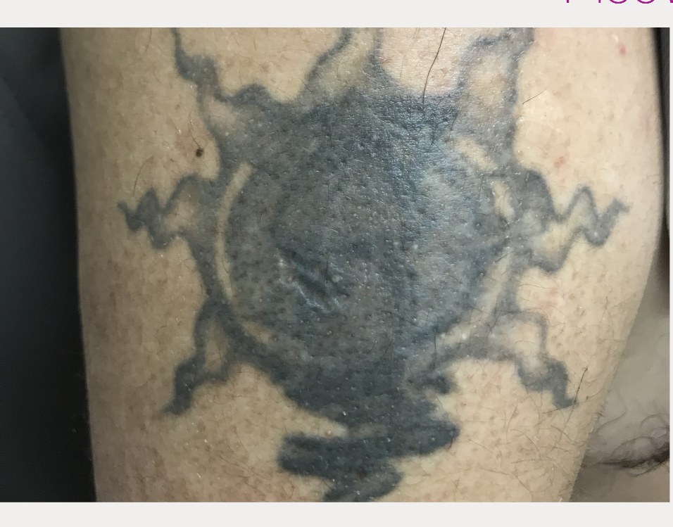 Before laser tattoo removal — Calf · Large Black